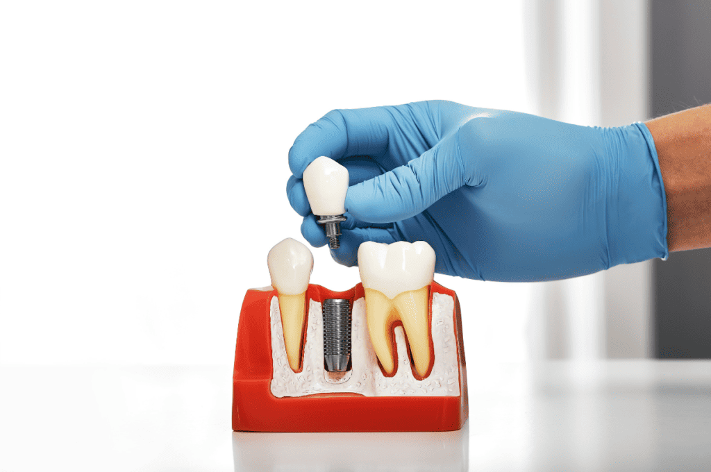 Comparing Dental Implants