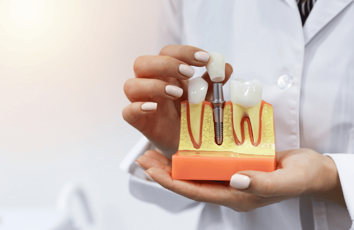 Benefits of Dental Implants: Enhancing Oral Health and Quality of Life