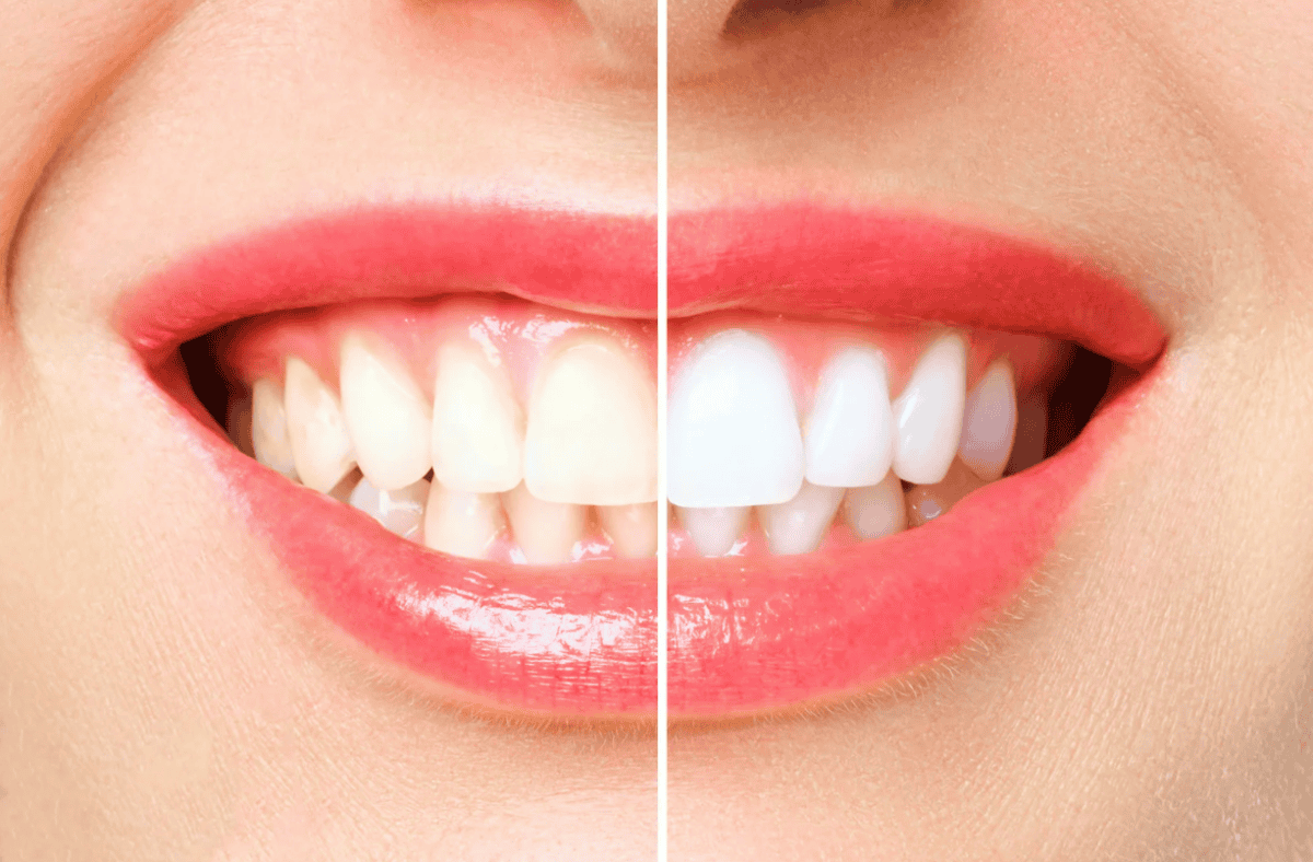 Surprising Insights: 5 Things You Didn’t Know About Teeth Whitening