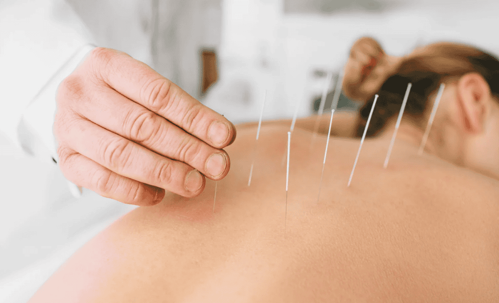 Acupuncture for Holistic Wellness