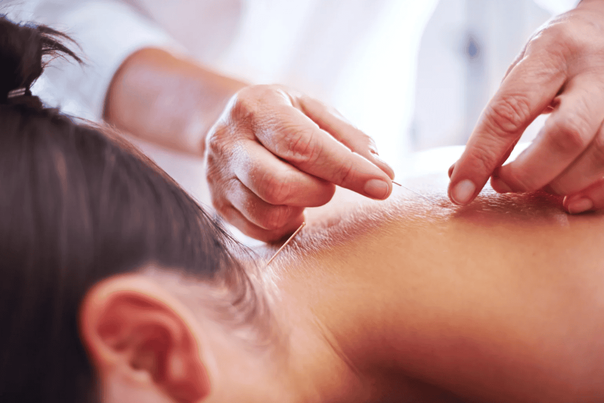 Acupuncture for Holistic Health: Addressing Physical and Emotional Wellness