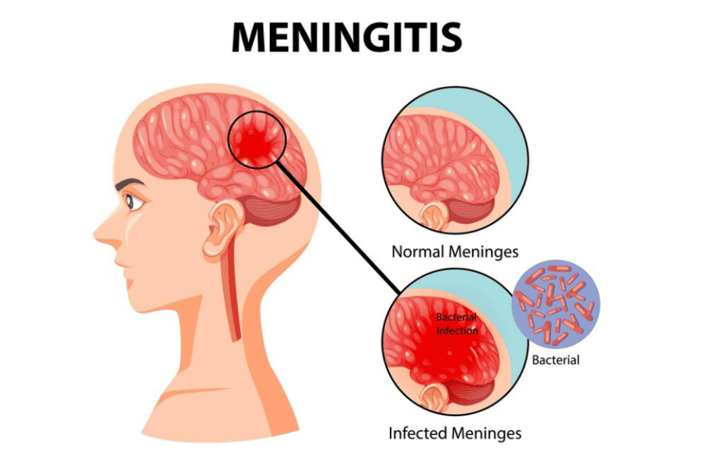 What is Meningioma