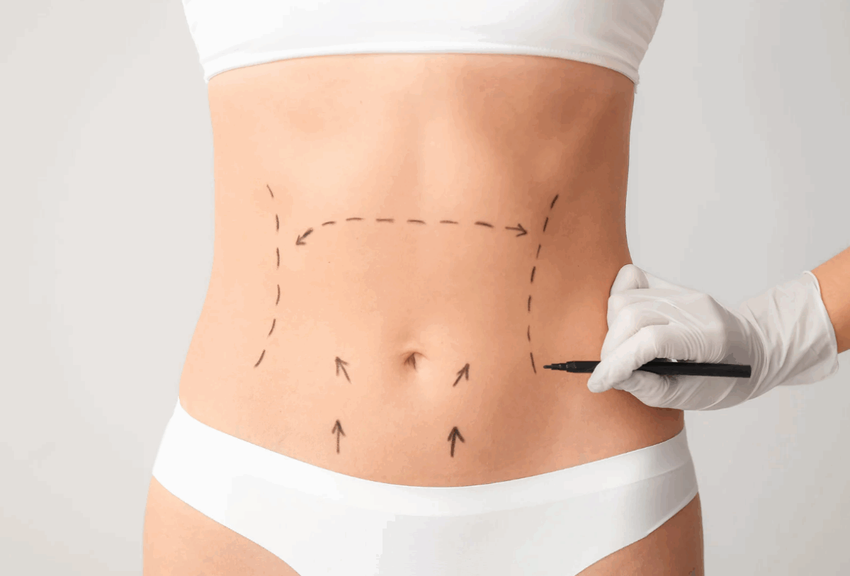 Undergoing Abdominoplasty Surgery