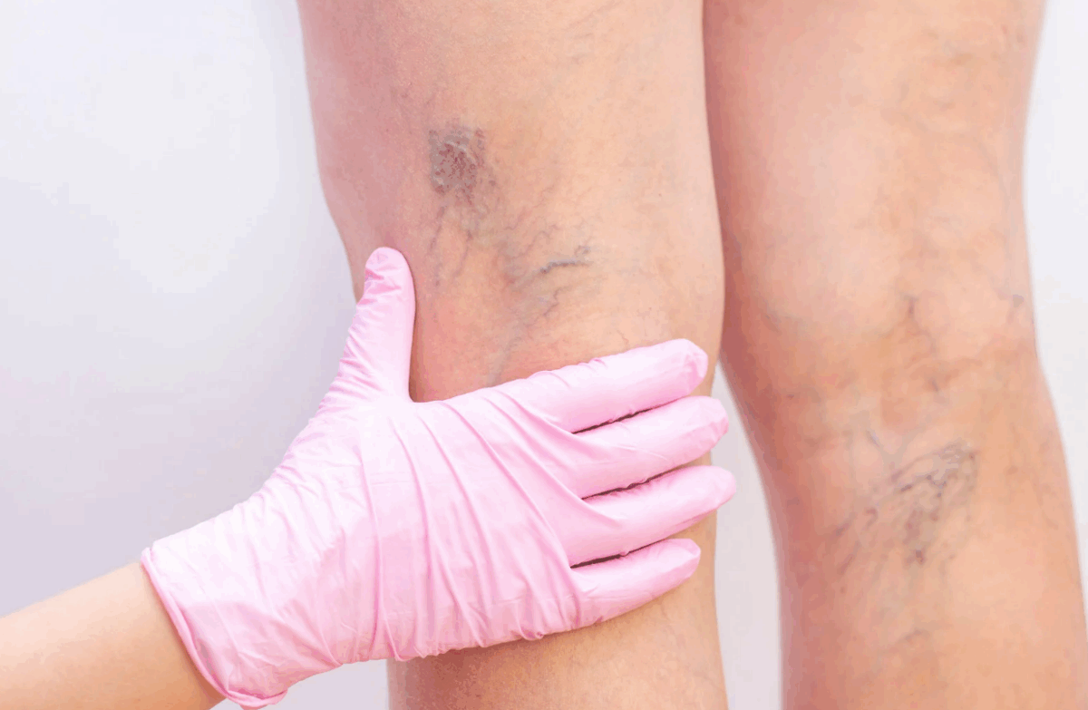 Relation of Mental Health and Varicose Veins