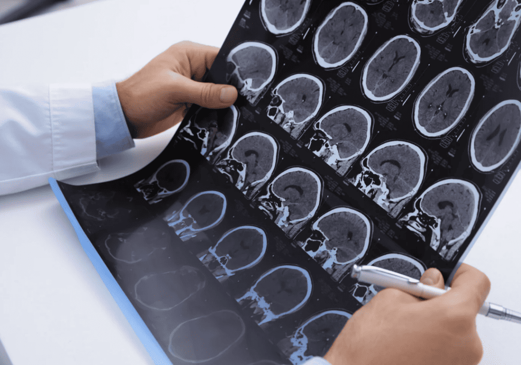 handling multiple sclerosis