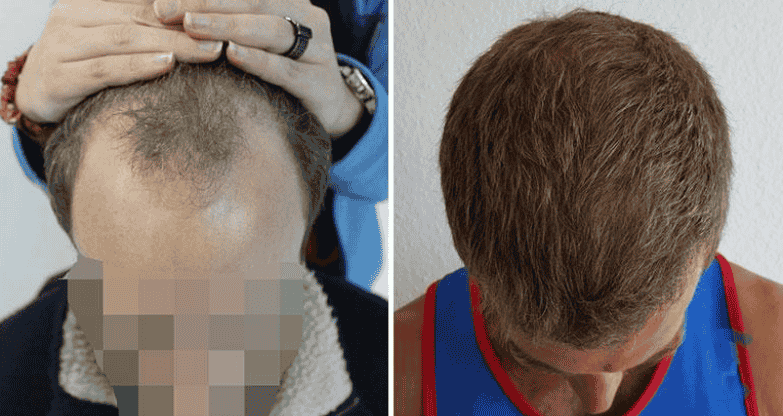 Certified hair restoration business