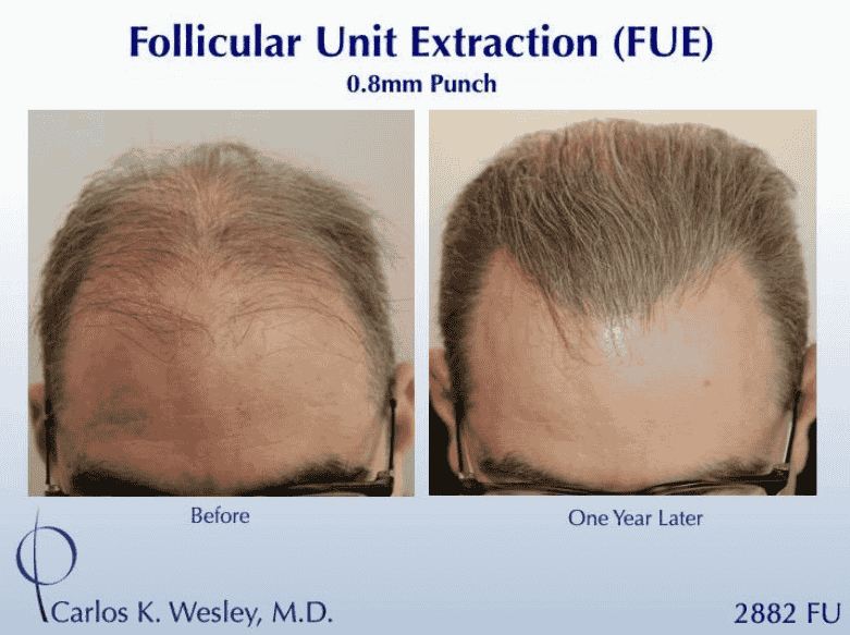 Advanced hair restoration business