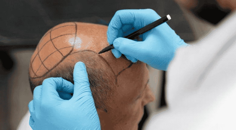 running a hair restoration business