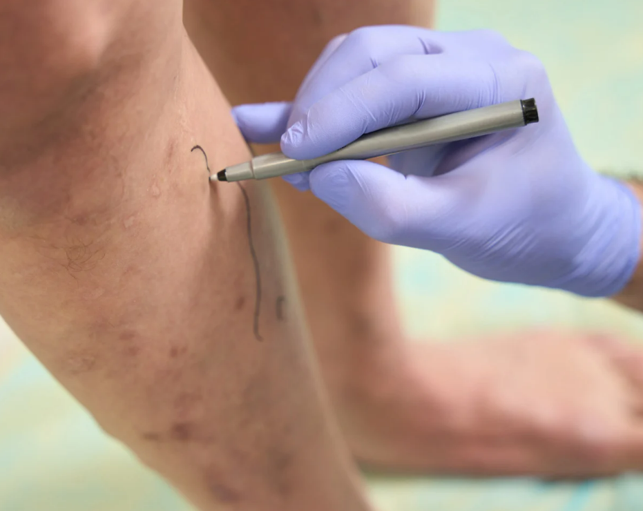 hidden benefits of vein treatment